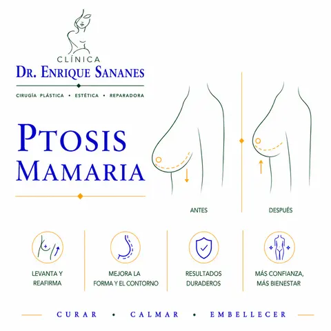 Ptosis mamaria (levantamiento mamario) - Clínica Dr. Enrique Sananes