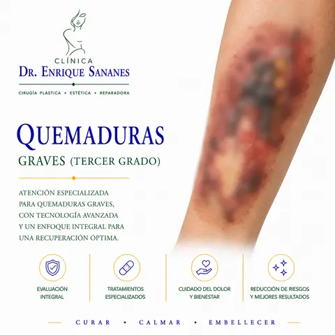 Quemaduras graves - Clínica Dr. Enrique Sananes