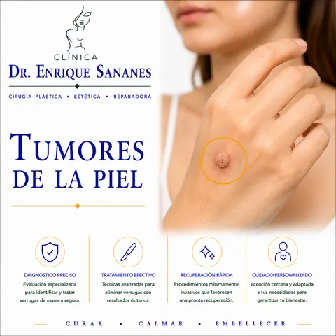Tumores de la piel II - Clínica Dr. Enrique Sananes