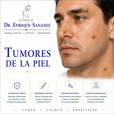 Tumores de la piel III - Clínica Dr. Enrique Sananes